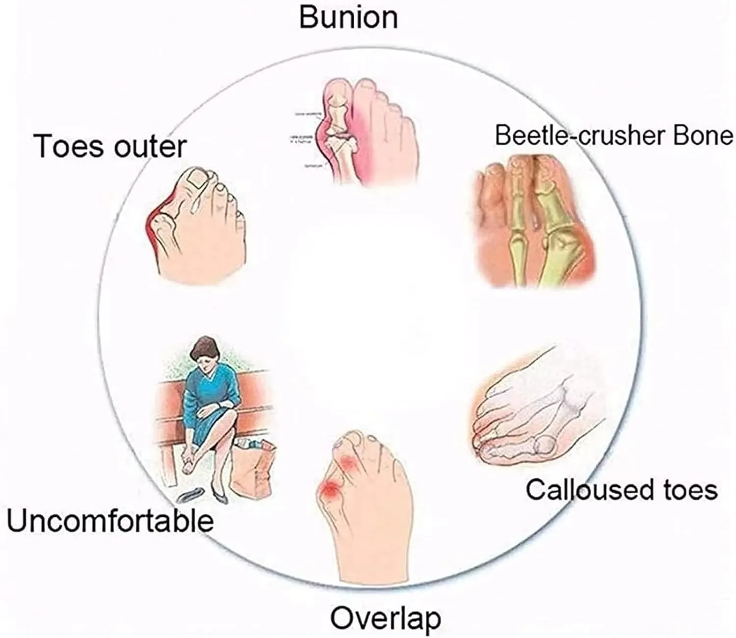 Men's Beach Sandals Summer Lightweight Ring Toe Bunion Flat Slippers, Casual Soft Non-Slip Foot Correction Men's Beach Sandals for Plantar Fasciitis